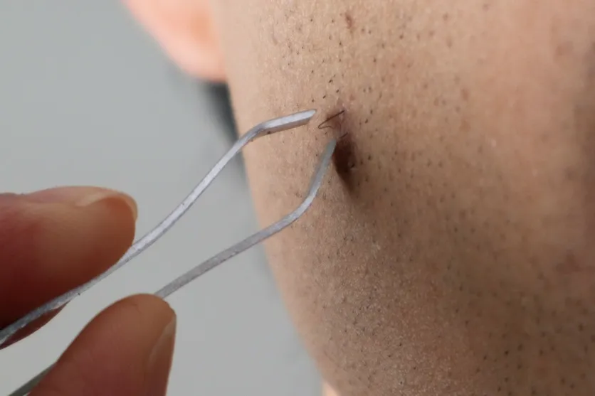 eingewachsene haare entfernen