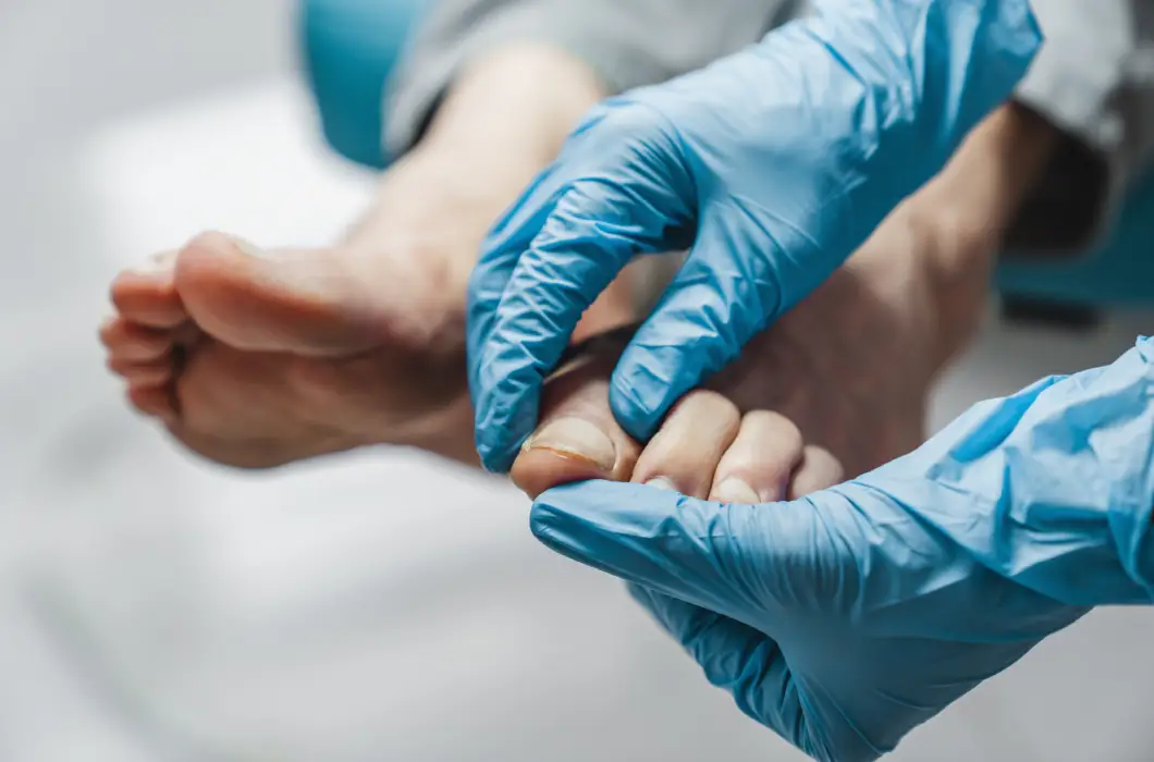 Grzybica paznokci – leczenie i profilaktyka